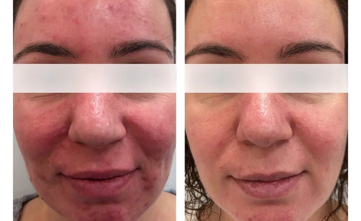 Valoración para Rosácea - Procedimientos especializados LASKIN PRO - LASKIN