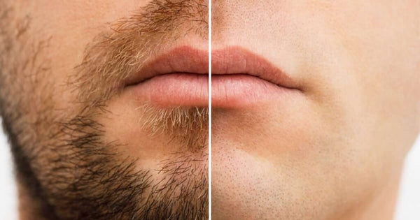 Antes Y Laser En Cara Para Vello Depilación Láser Bigote (Para