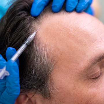 Mesoterapia Capilar [NCTF] - 15% Dcto - 1 Sesión