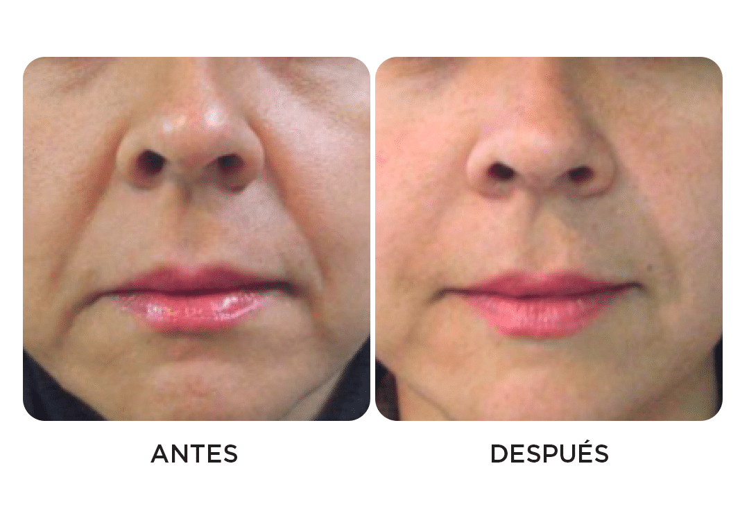 Valoración Para Procedimientos Especializados - LASKIN Pro (Rejuvenecimiento Facial 4D - Láser Fotona) - LASKIN