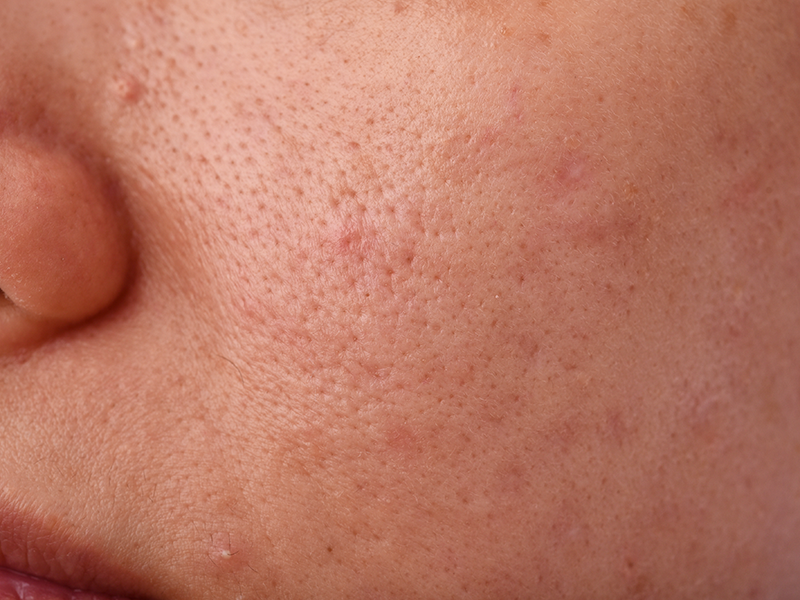 Soluciones efectivas para Poros Dilatados con Laskin – LASKIN