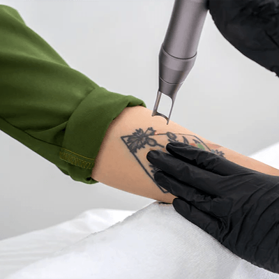 Valoración para Eliminación de Tatuajes - Procedimientos especializados LASKIN PRO - LASKIN