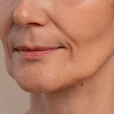 Valoración para Flacidez Facial - Procedimientos especializados LASKIN PRO - LASKIN